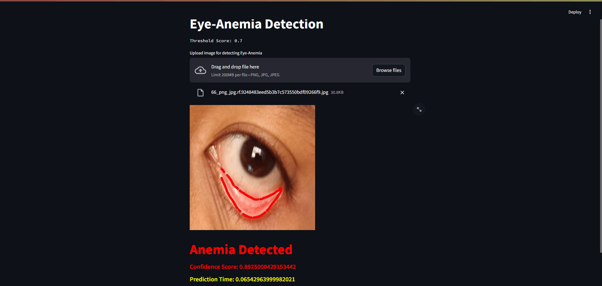 Anemia Detection from Eye Conjunctiva Images using the Roboflow Inference SDK